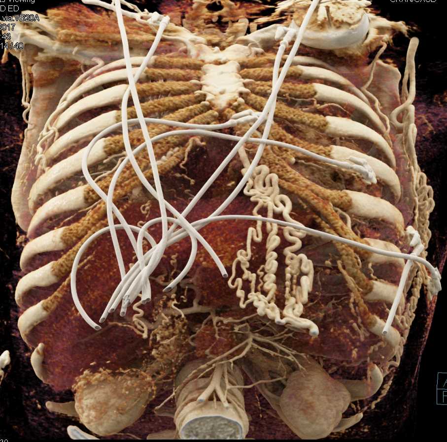 Bleed from Ascending Aorta Repair - CTisus CT Scan
