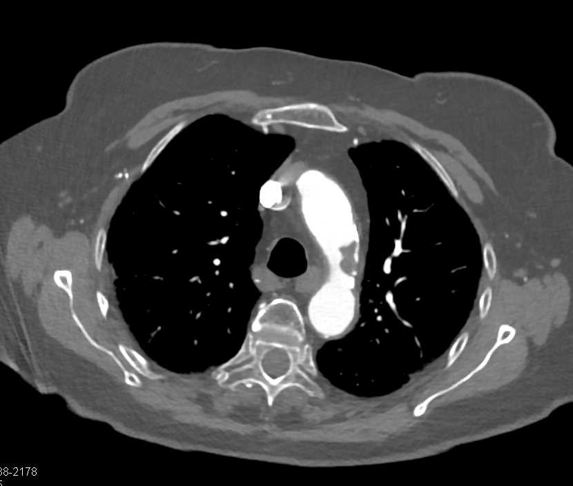 Multiple Thrombi in the Aorta - CTisus CT Scan