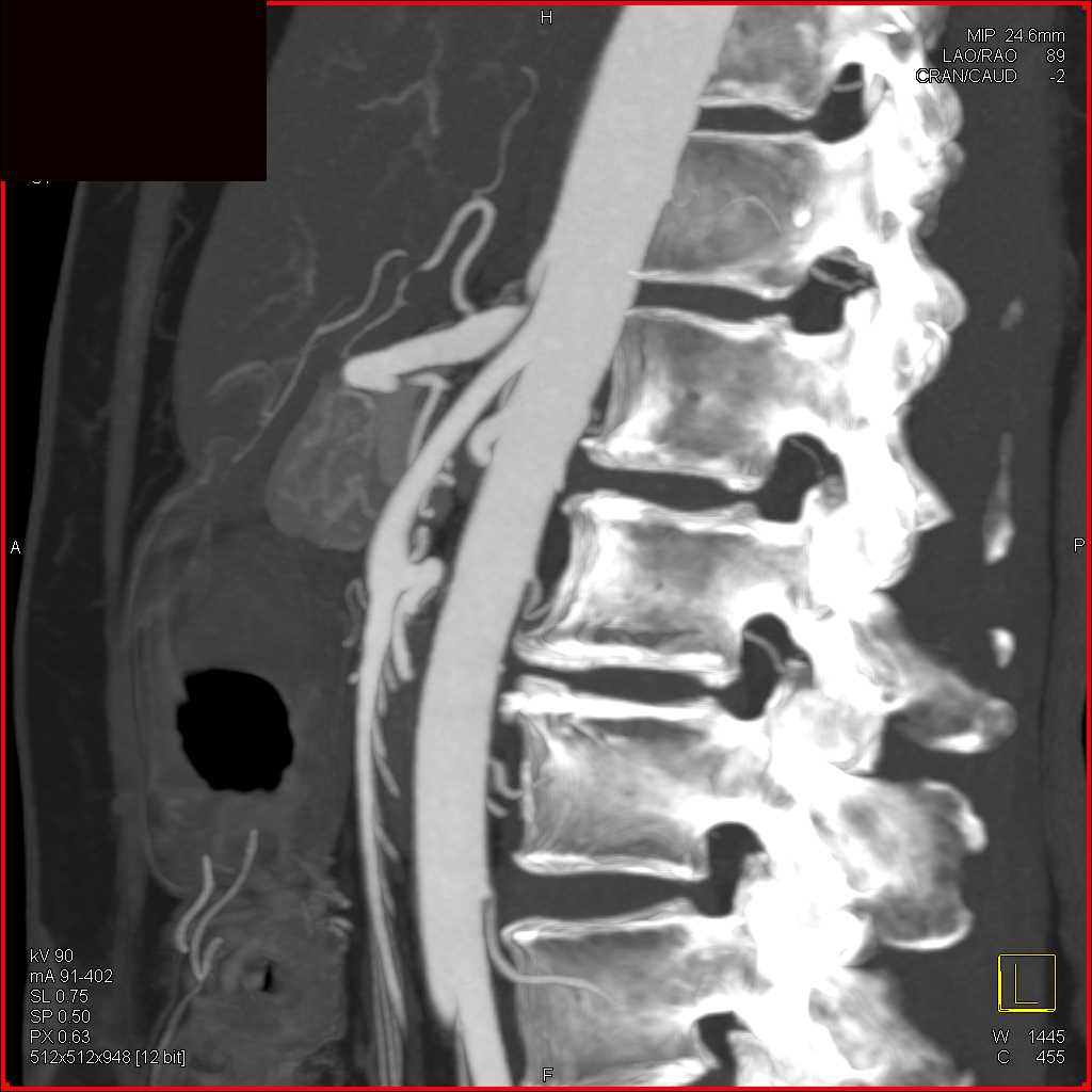 Celiac Stenosis with Collaterals due to Median Arcuate Ligament Syndrome - CTisus CT Scan