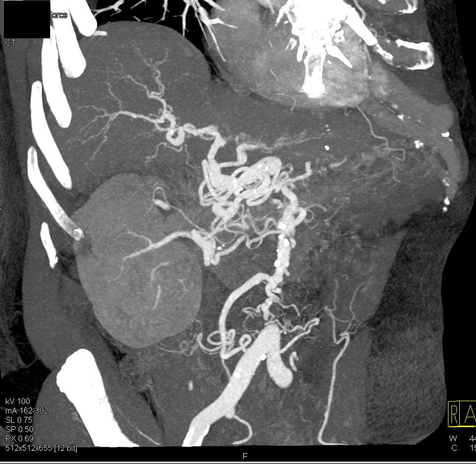 Celiac Stenosis with Collaterals due to Median Arcuate Ligament Syndrome - CTisus CT Scan