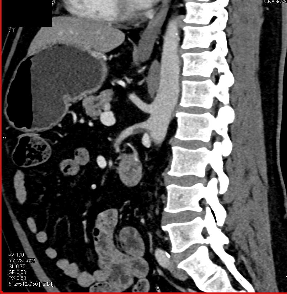 Thrombus Narrows the Superior Mesenteric Artery (SMA) - CTisus CT Scan