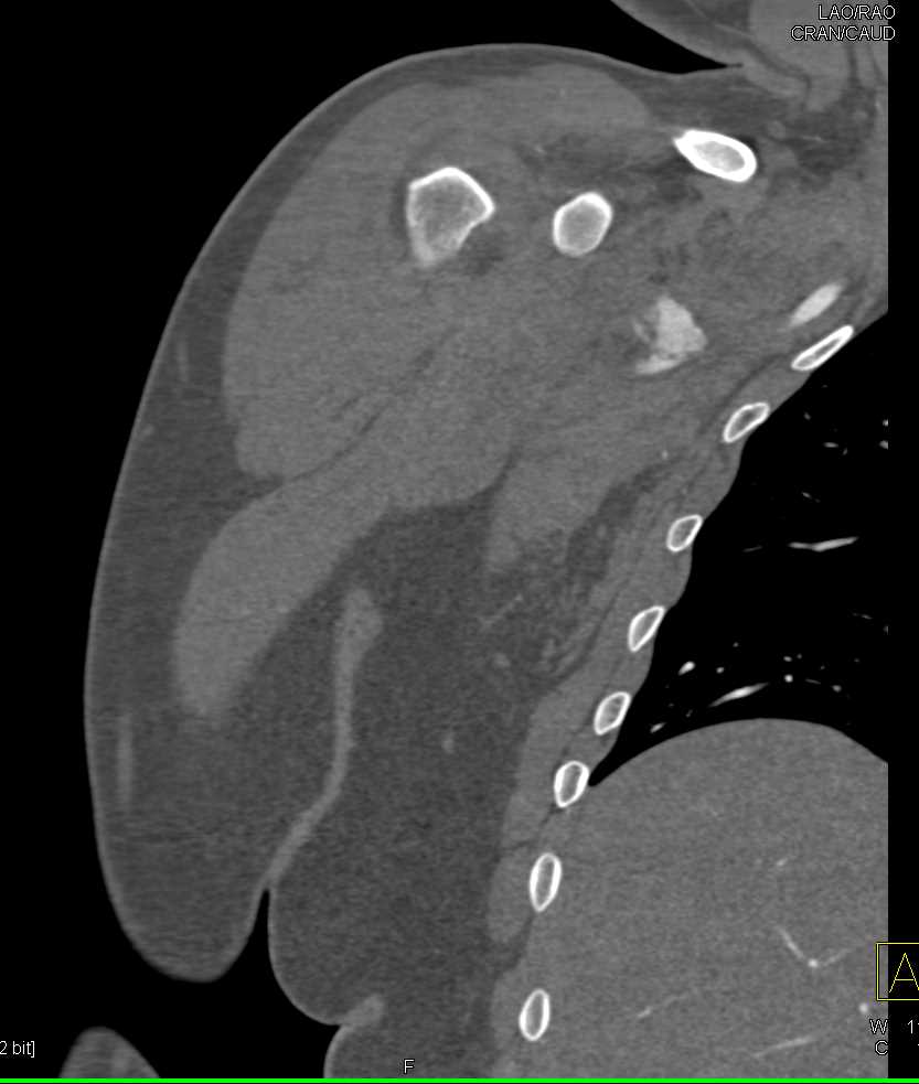 Active Bleed Axillary Artery - CTisus CT Scan