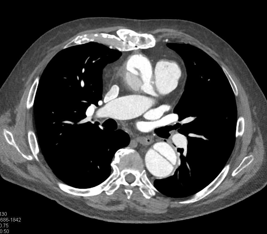 Type A Aortic Dissection - CTisus CT Scan