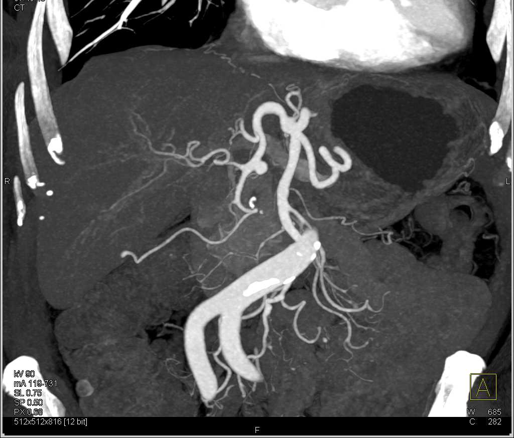 Gastroduodenal Artery (GDA) Aneurysm - CTisus CT Scan