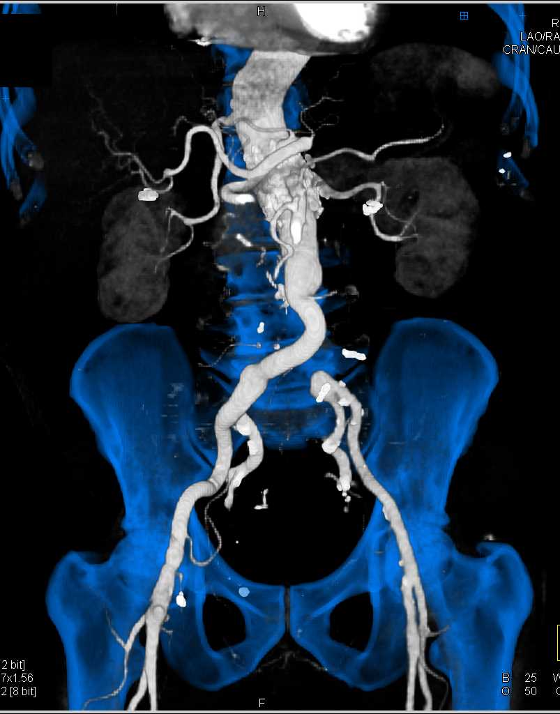 Occluded Left Common Iliac Artery - CTisus CT Scan