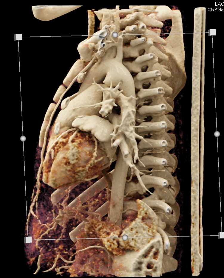 Ductus Aneurysm with Cinematic Rendering - CTisus CT Scan