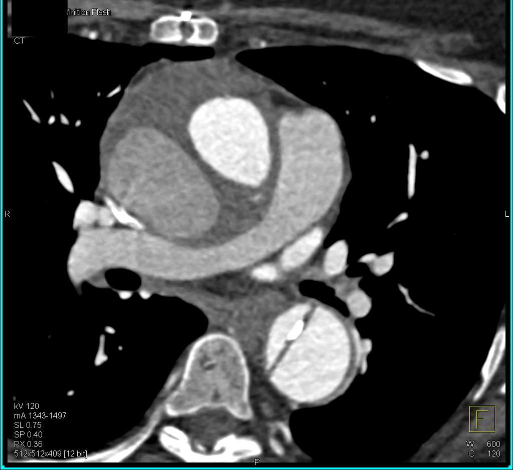 Type A Dissection Extends into the Abdomen - CTisus CT Scan