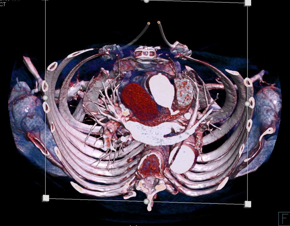 Type A Dissection Extends into the Abdomen - CTisus CT Scan