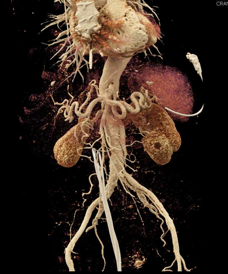 Type A Dissection Extends into the Abdomen - CTisus CT Scan