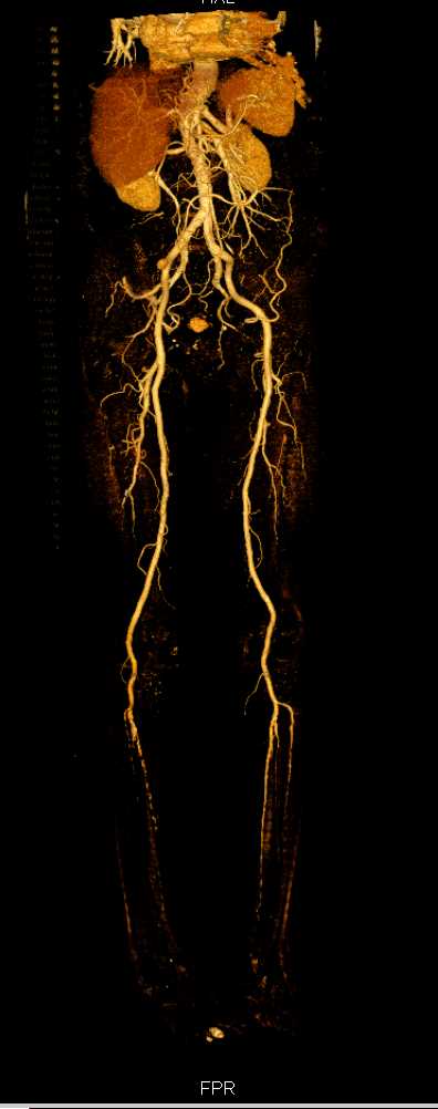 CTA Runoff with Bone Removal and Peripheral Arterial Disease (PAD) - CTisus CT Scan