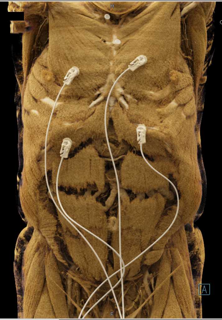 Vascular Mapping Aorta and Abdominal Musculature - CTisus CT Scan