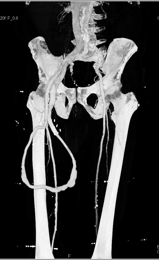 AV Fistulae in Right Upper Thigh - CTisus CT Scan