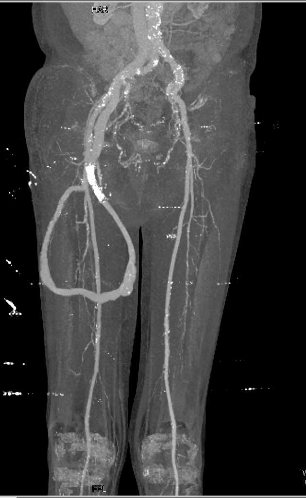 AV Fistulae in Right Upper Thigh - CTisus CT Scan