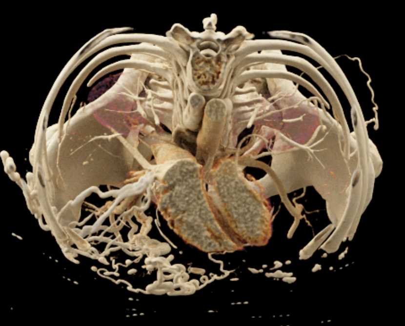 Extensive Abdominal Wall Collaterals with Distal Inferior Vena Cava (IVC) Occlusion - CTisus CT Scan