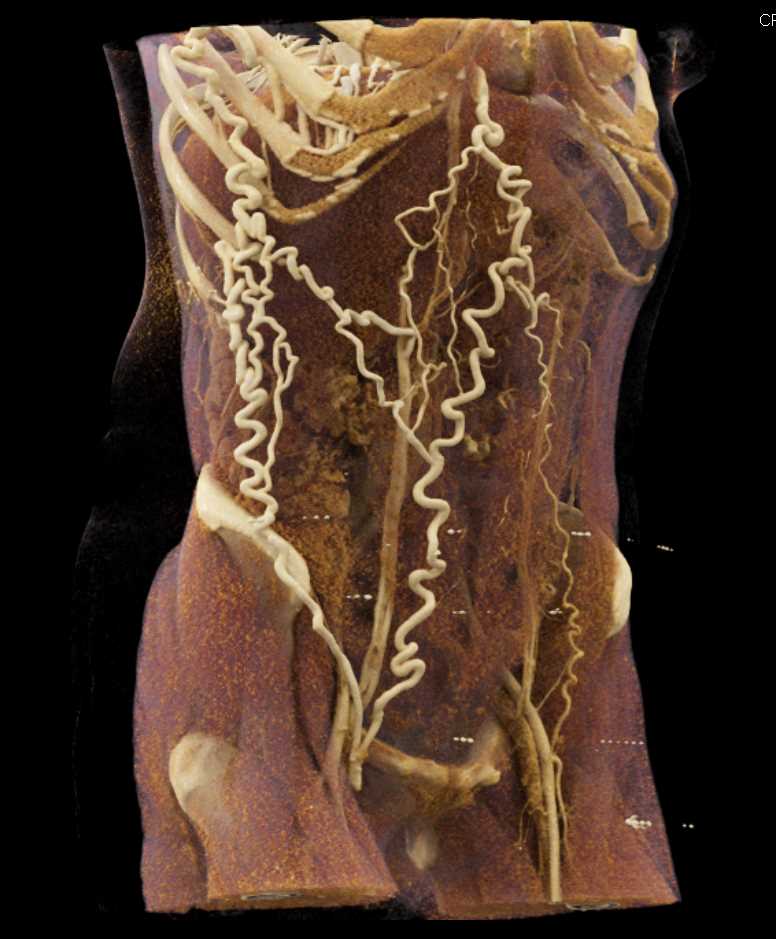 Extensive Abdominal Wall Collaterals with Distal Inferior Vena Cava (IVC) Occlusion - CTisus CT Scan