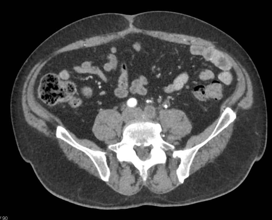 Inferior Vena Cava (IVC) and Left Common Iliac Vein Occlusion - CTisus CT Scan