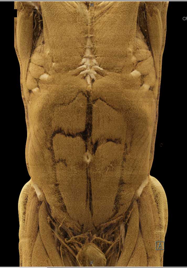 Mesenteric Arcade - CTisus CT Scan