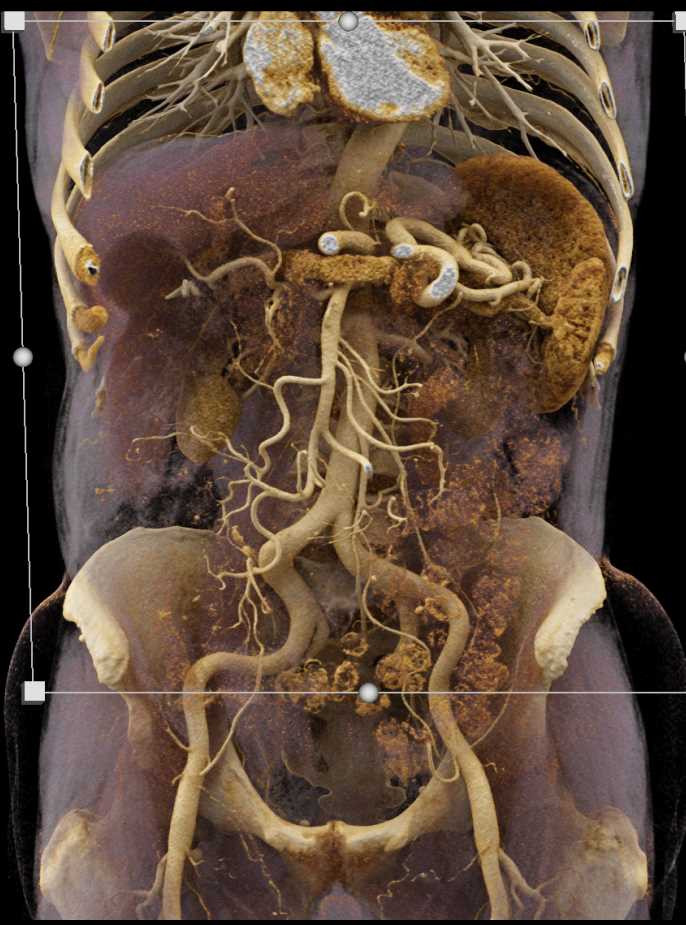 Mesenteric Arcade - CTisus CT Scan