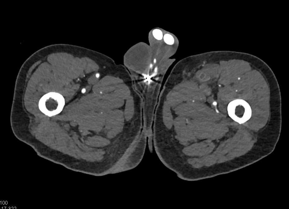 Superficial Femoral Artery (SFA) Occlusion on the Left - CTisus CT Scan