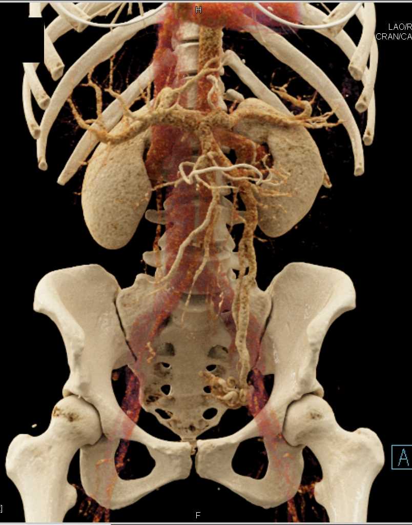 Prominent Gonadal Veins - CTisus CT Scan