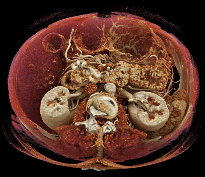 Celiac Occlusion with Collaterals Thru a Dilated Gastroduodenal Artery (GDA) with Cinematic Rendering - CTisus CT Scan