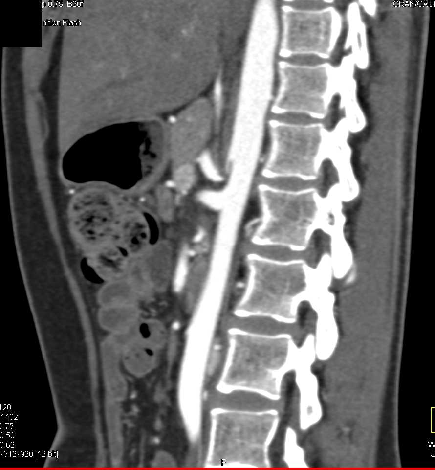 Celiac Stenosis with Median Arcuate Ligament Syndrome (MALS) - CTisus CT Scan