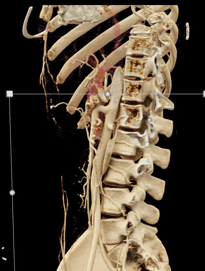 Compression of the Celiac Axis with Cinematic Rendering - CTisus CT Scan