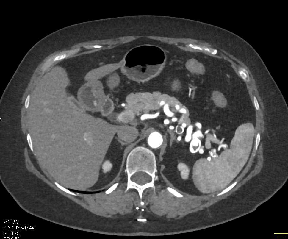 Splenic Artery Aneurysms - CTisus CT Scan