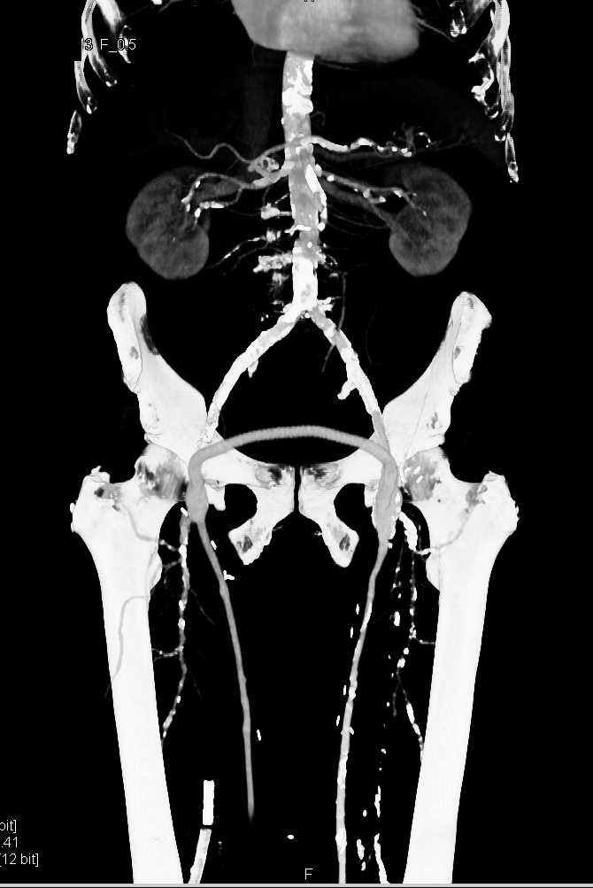 Peripheral Vascular Disease (PVD) on CTA with Bilateral Fem-Popliteal Bypasses - CTisus CT Scan