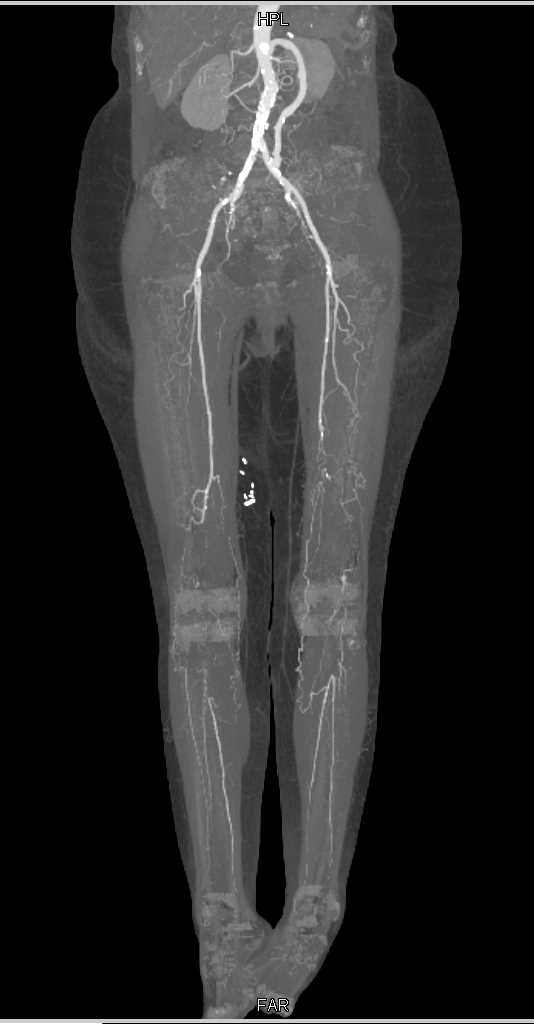 Peripheral Vascular Disease - CTisus CT Scan