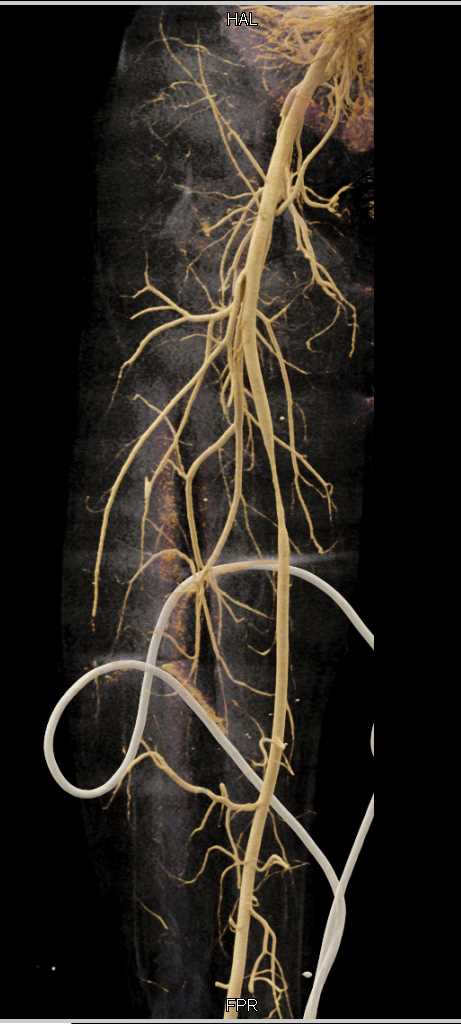 Trauma with Spasm Superficial Femoral Artery (SFA) - CTisus CT Scan
