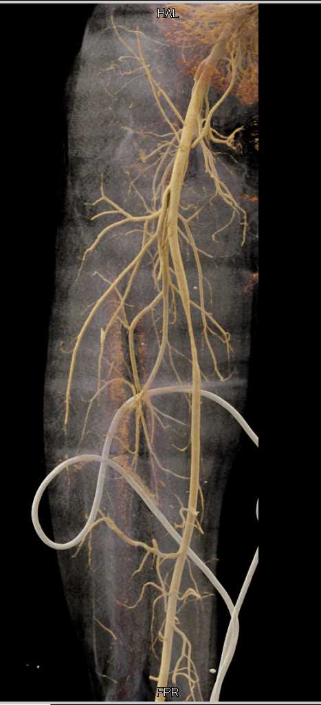 Trauma with Spasm Superficial Femoral Artery (SFA) - CTisus CT Scan