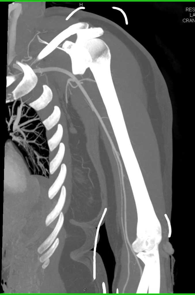 Patent Brachial Artery - CTisus CT Scan