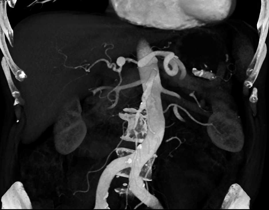 Hepatic Artery Aneurysm - CTisus CT Scan