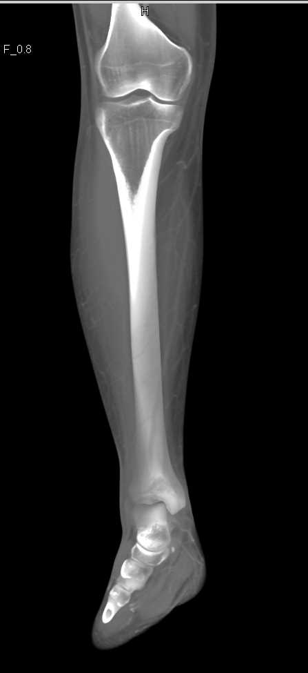 CT Angiogram Without Vascular Injury - CTisus CT Scan