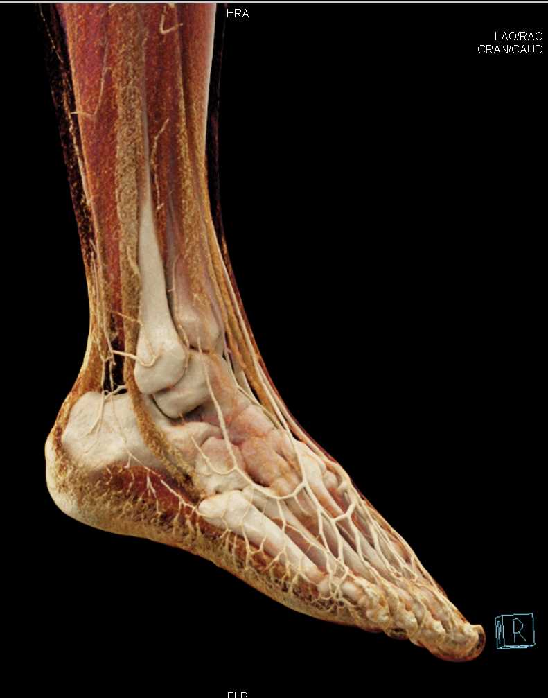 CT Angiogram Without Vascular Injury - CTisus CT Scan