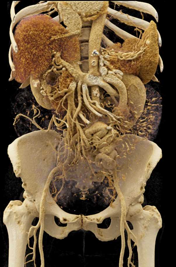 Extensive Mesenteric Venous Collaterals - CTisus CT Scan