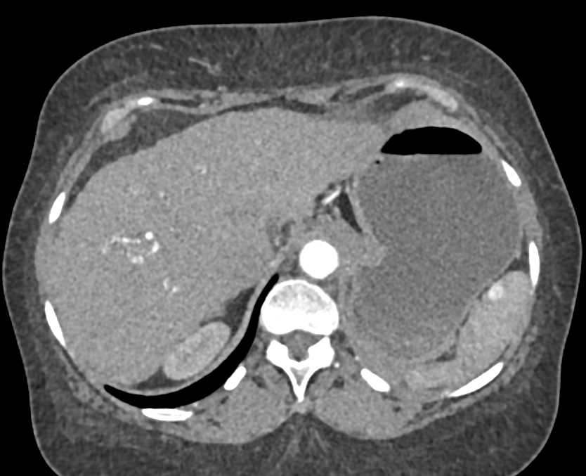 Extensive Venous Collaterals due to Portal Vein Thrombosis (PVT) - CTisus CT Scan