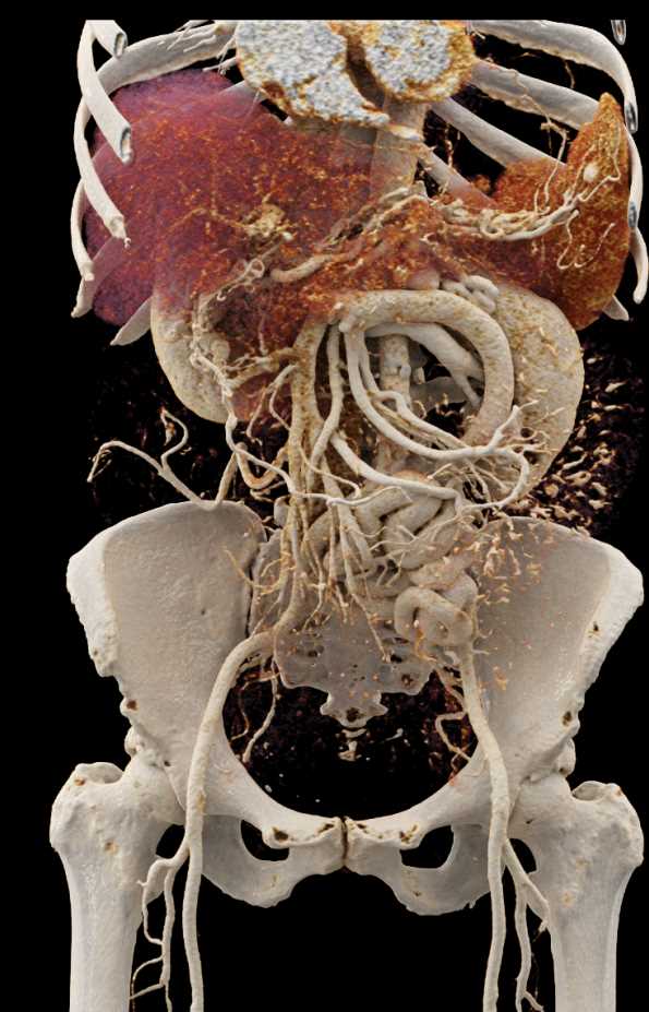 Extensive Venous Collaterals due to Portal Vein Thrombosis (PVT) - CTisus CT Scan