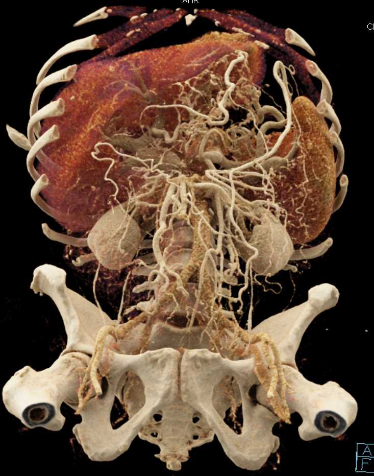 Vascular Mapping of the Pancreas - CTisus CT Scan