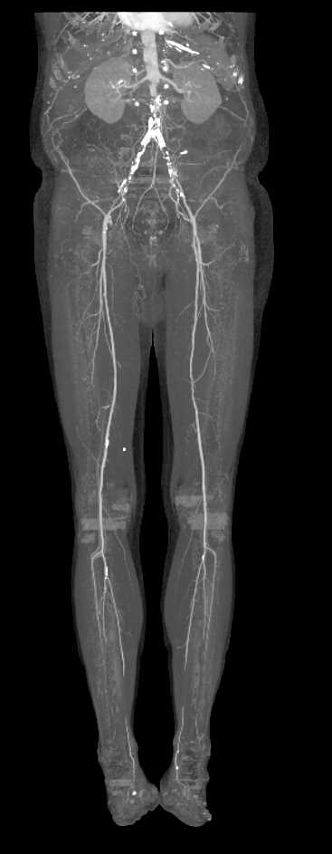 Occlusion of the Common Illiac Arteries Bilaterally - CTisus CT Scan