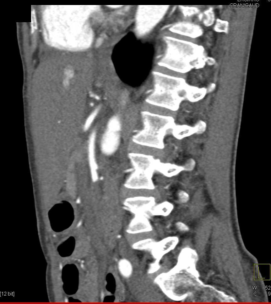 Distal Superior Mesenteric Artery (SMA) Occlusion - CTisus CT Scan