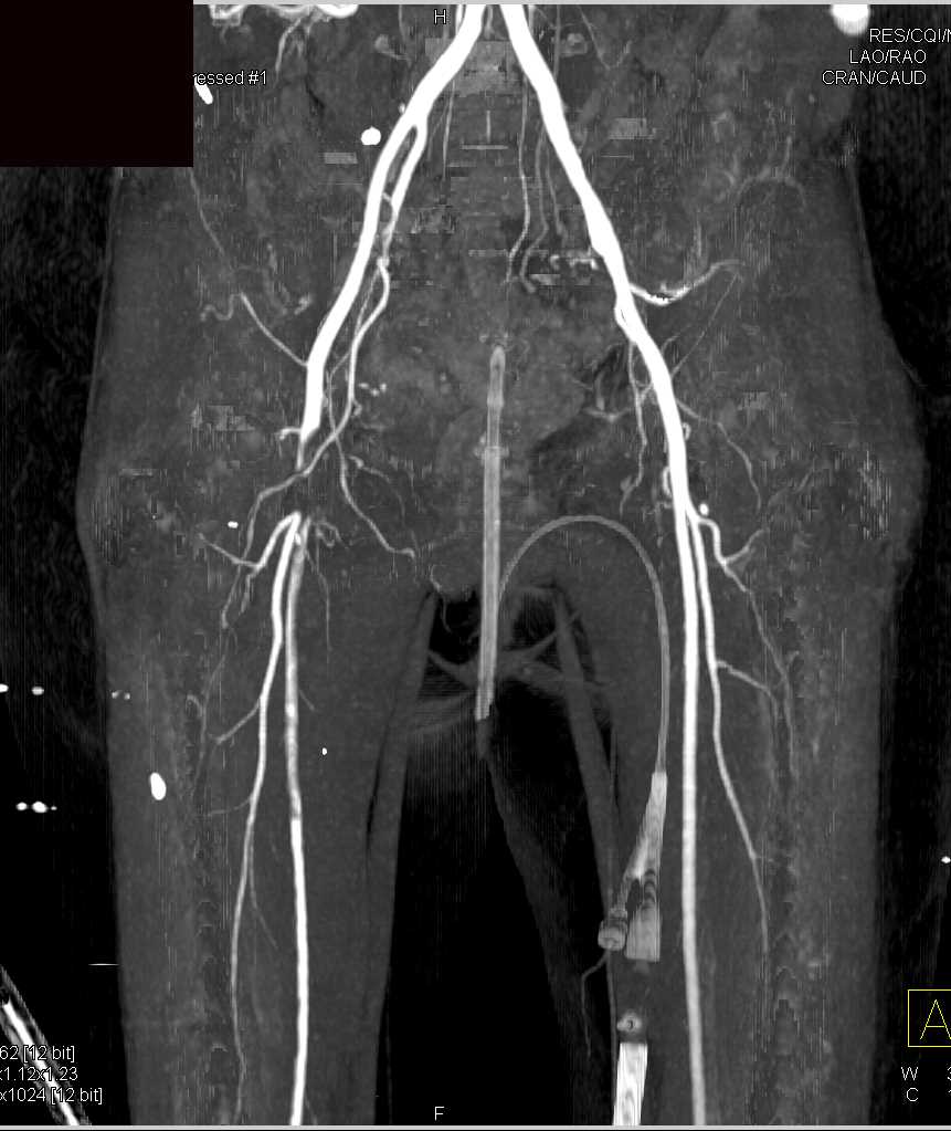 Right SFA Occlusion with PVD - CTisus CT Scan