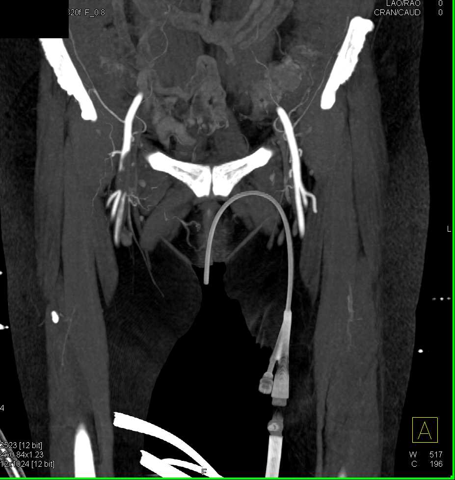 Right SFA Occlusion with PVD - CTisus CT Scan
