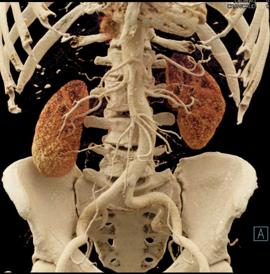 Vascular Mapping of the Aorta and Branch Vessels - CTisus CT Scan