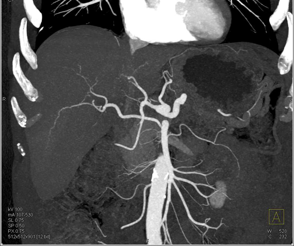 Replaced Right Hepatic Artery off the Superior Mesenteric Artery (SMA) - CTisus CT Scan