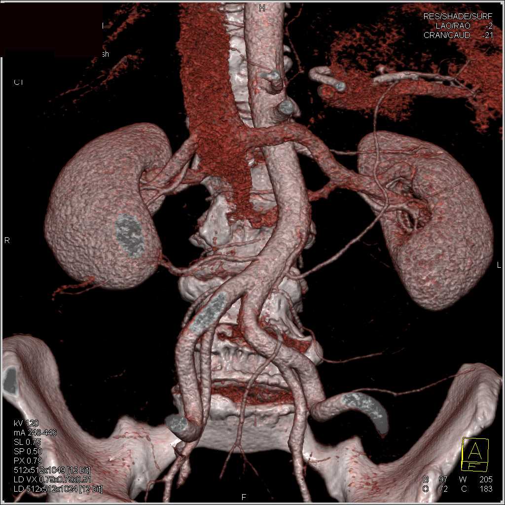 Circumaortic Left Renal Vein - CTisus CT Scan
