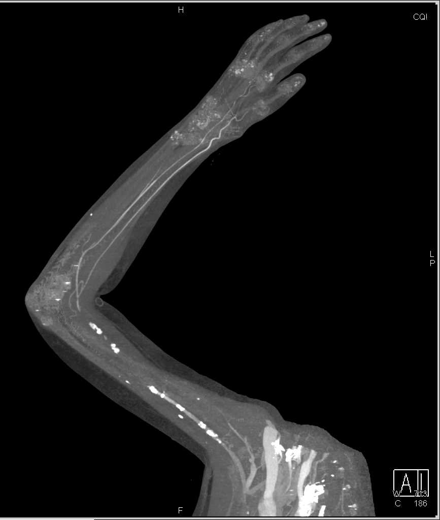 Extensive Disease in the Brachial Artery - CTisus CT Scan