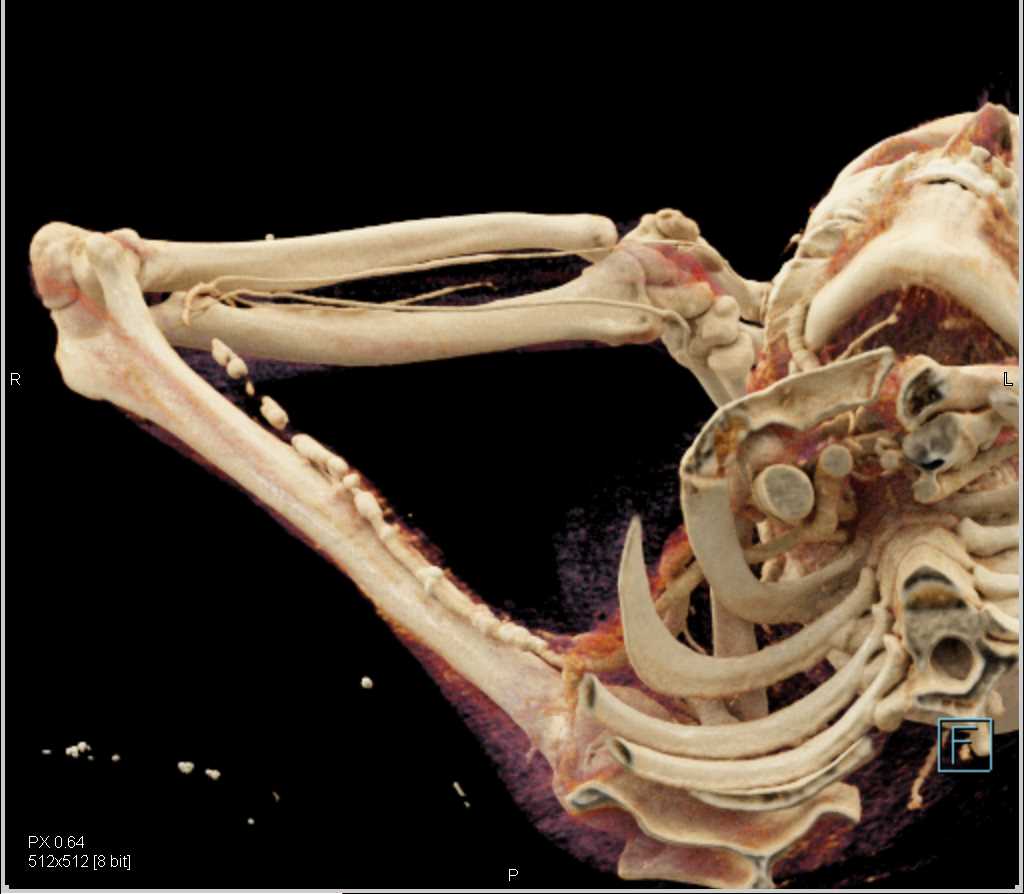 Extensive Disease in the Brachial Artery - CTisus CT Scan