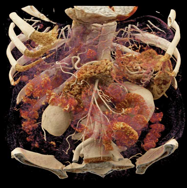 Cinematic Rendering (CR) Mapping of Pancreas and Mesenteric Arcade - CTisus CT Scan